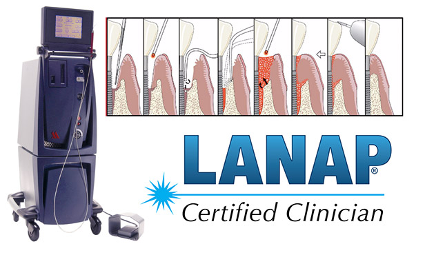 【レーザー】LANAP